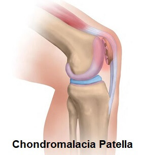Chondromalacia Patellae