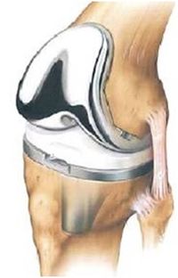 Post Total Knee Replacement (TKR) Rehabilitation