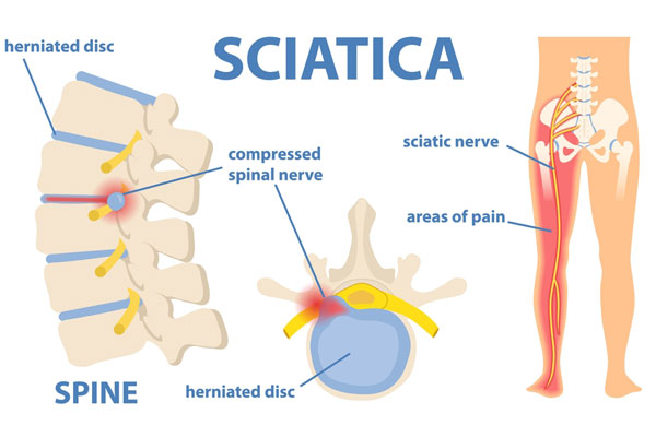 How Physiotherapy Can Help with Sciatica?